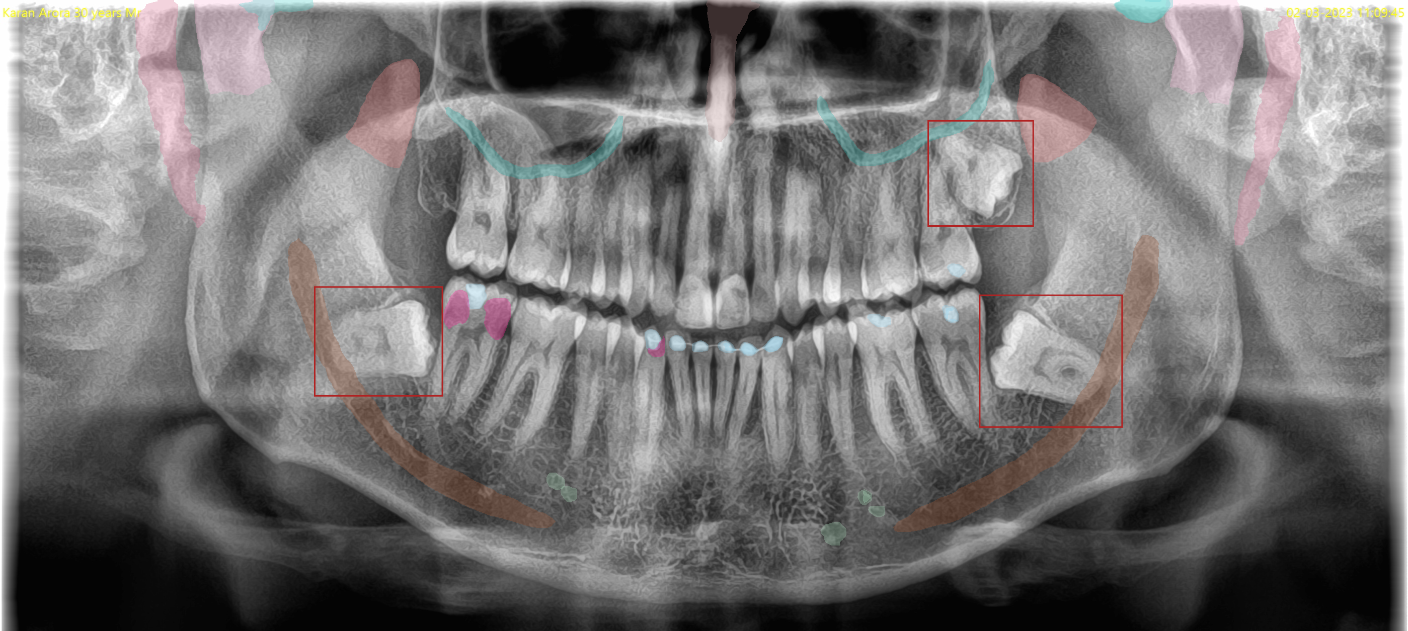 OPG X-ray analyzed