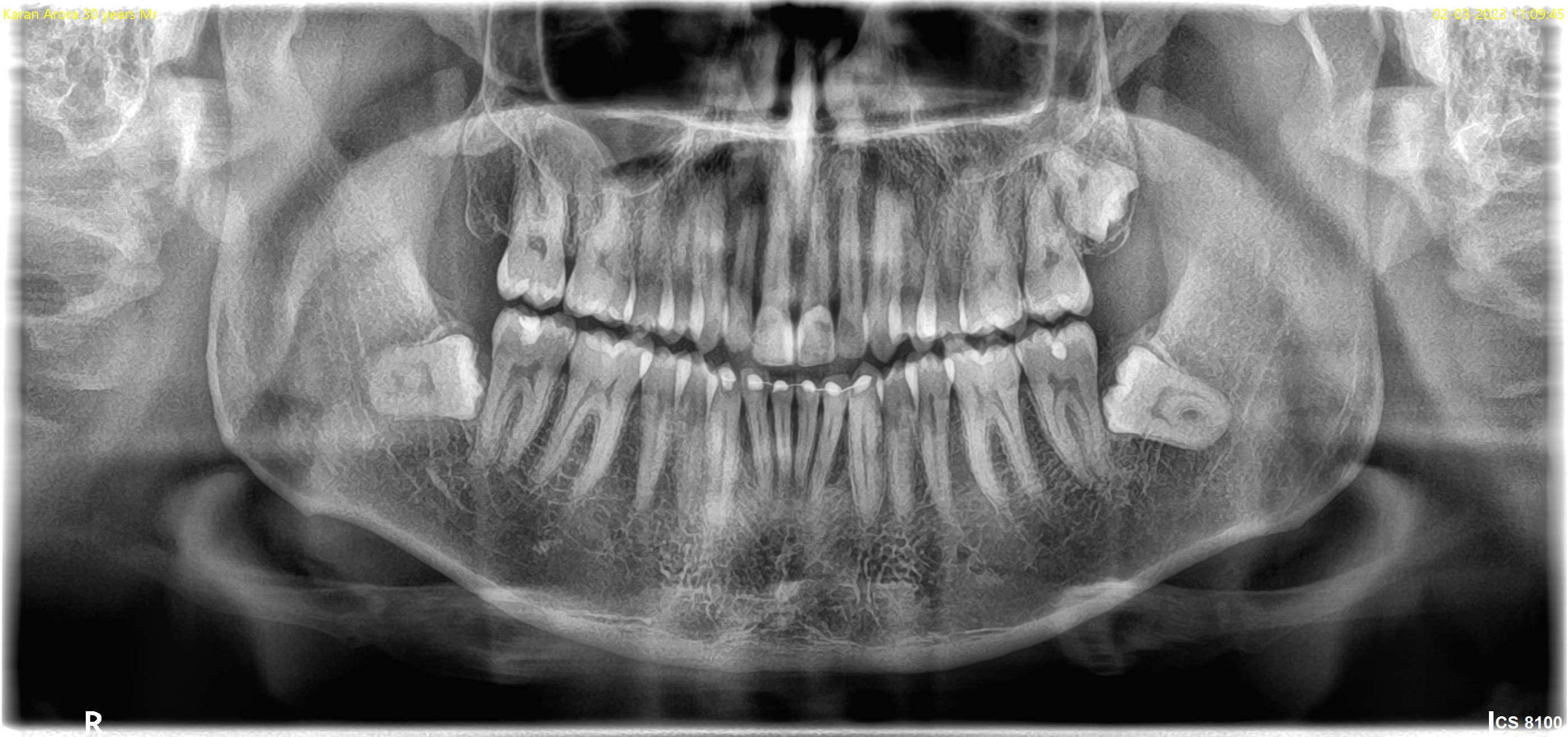 OPG X-ray